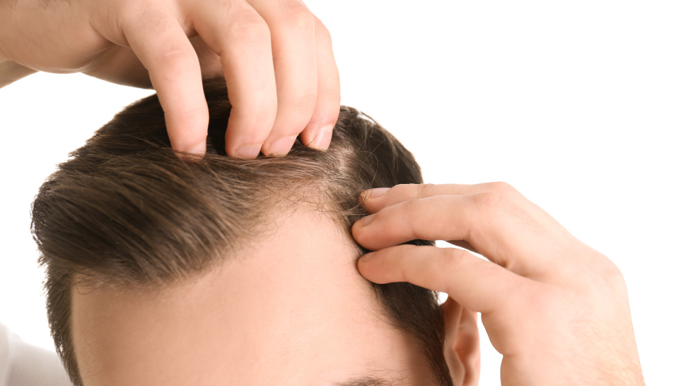 PRP treatment for hair loss: How you can naturally promote your hair growth