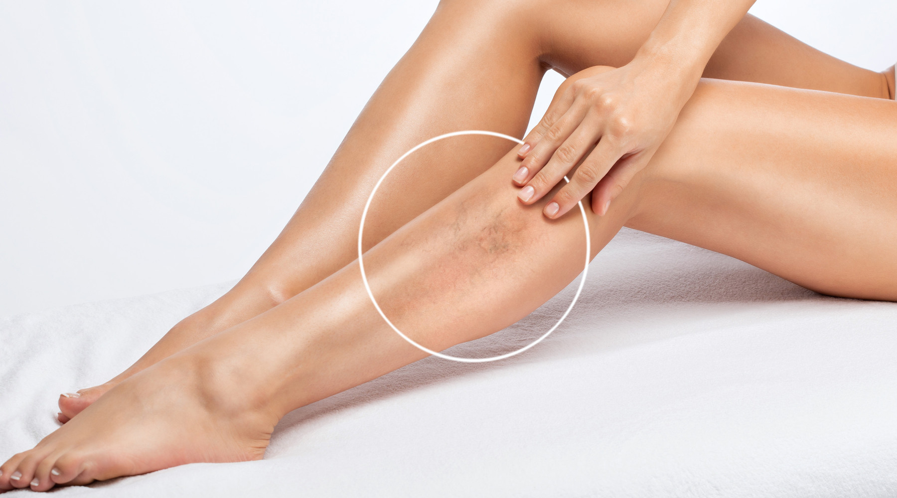 Sclerotherapy for spider veins