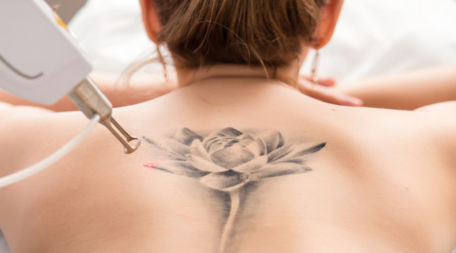 Tattoo removal