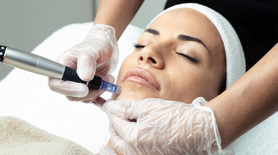 Microneedling