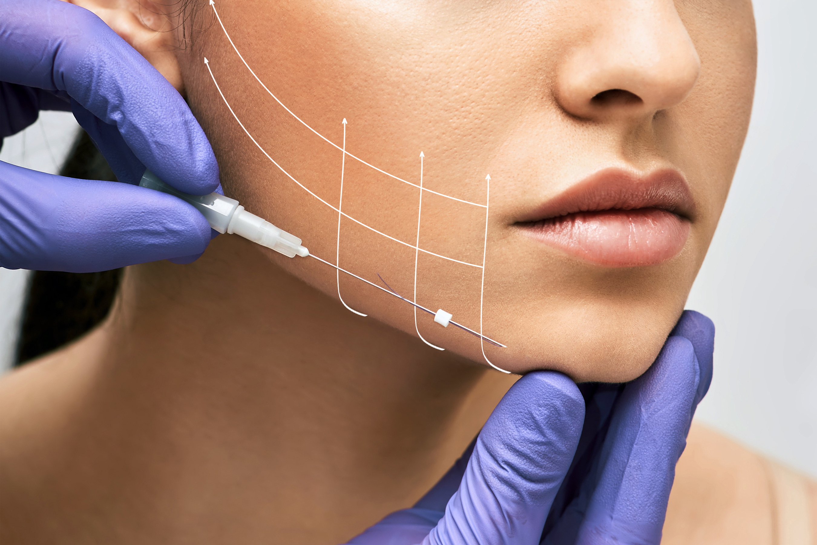 Faden Lifting Plastische Chirurgie Zürich Dermanence 001