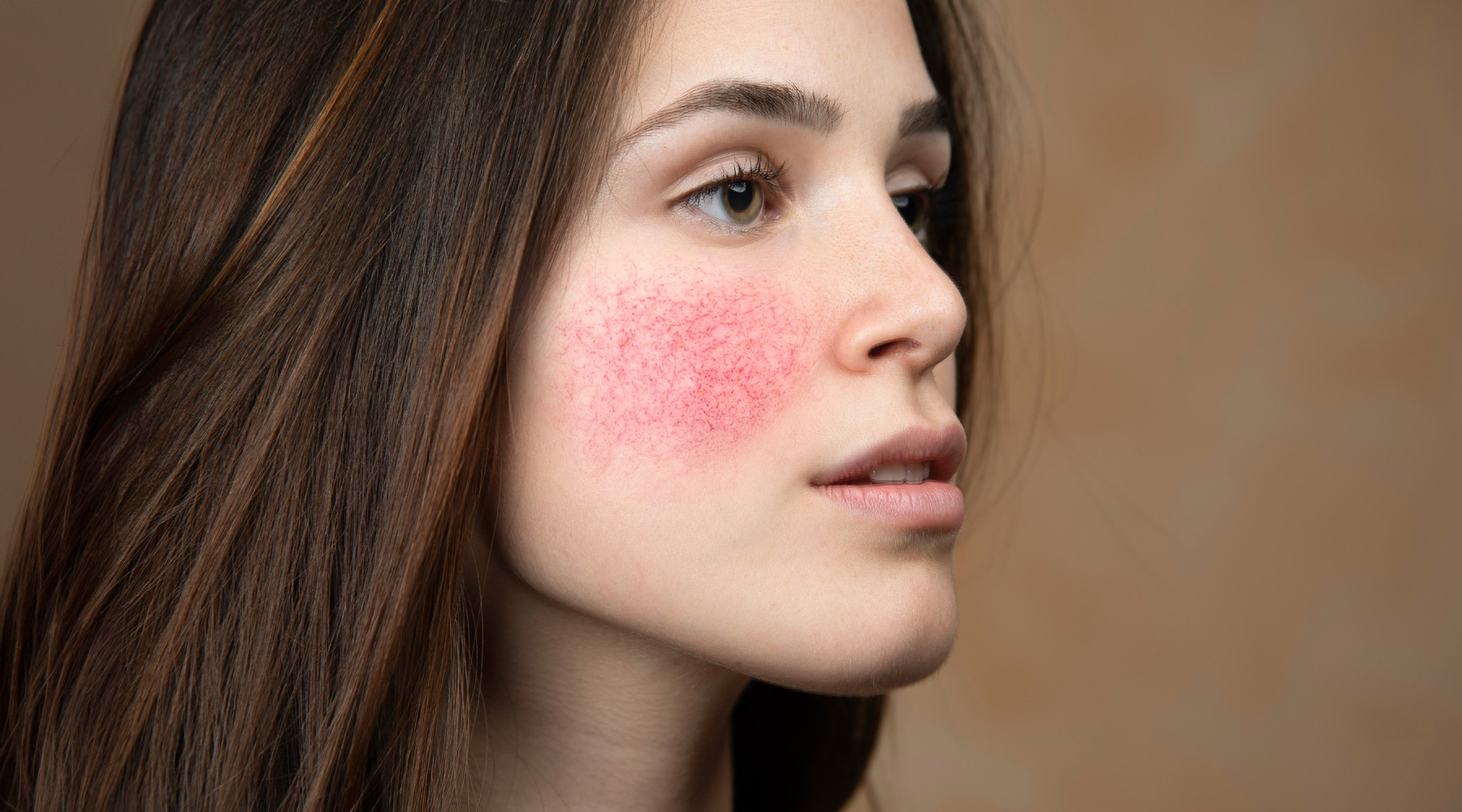 Blutgefässe, Blutschwämmchen und Rötungen