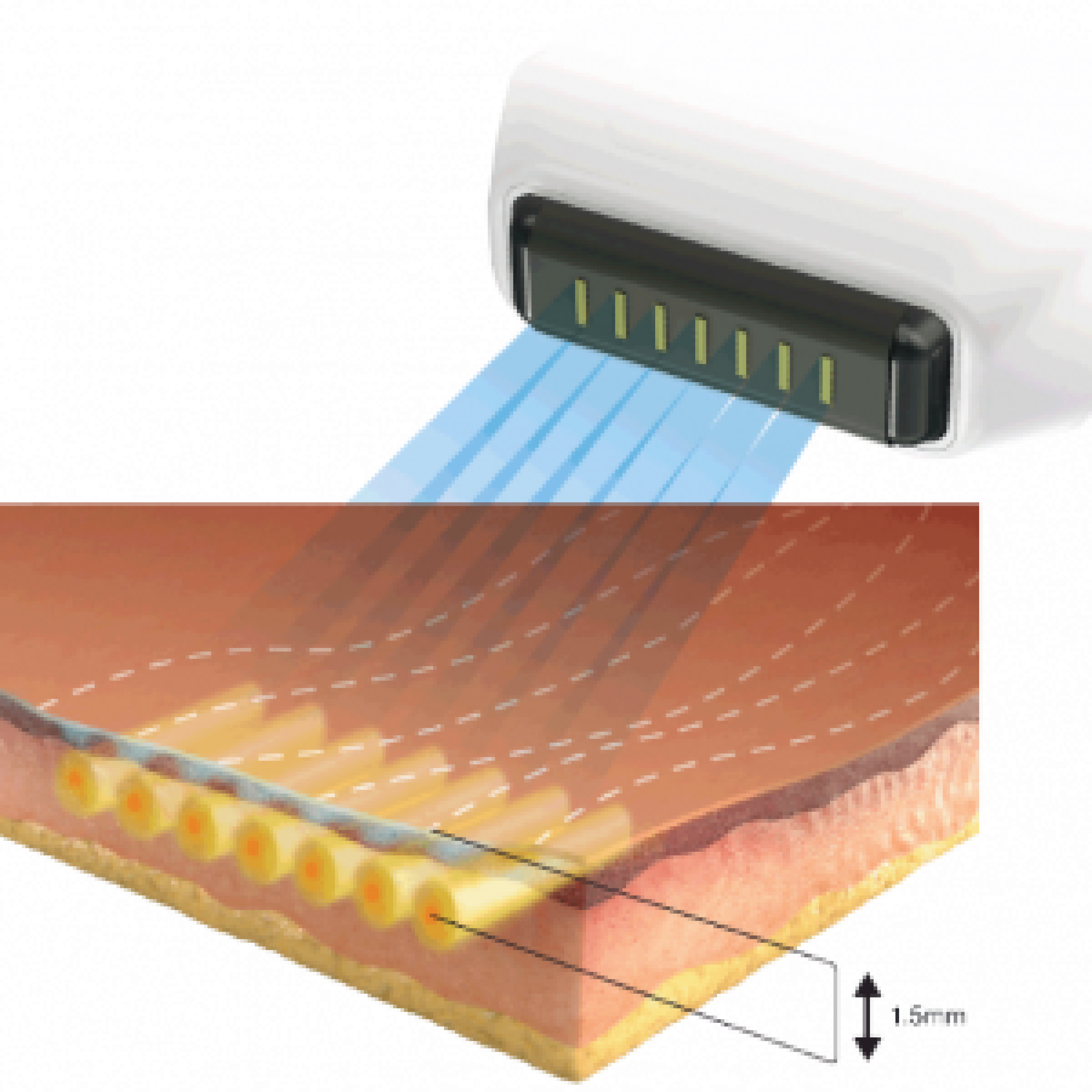 Sofwave ultrasound tightening Dermanence