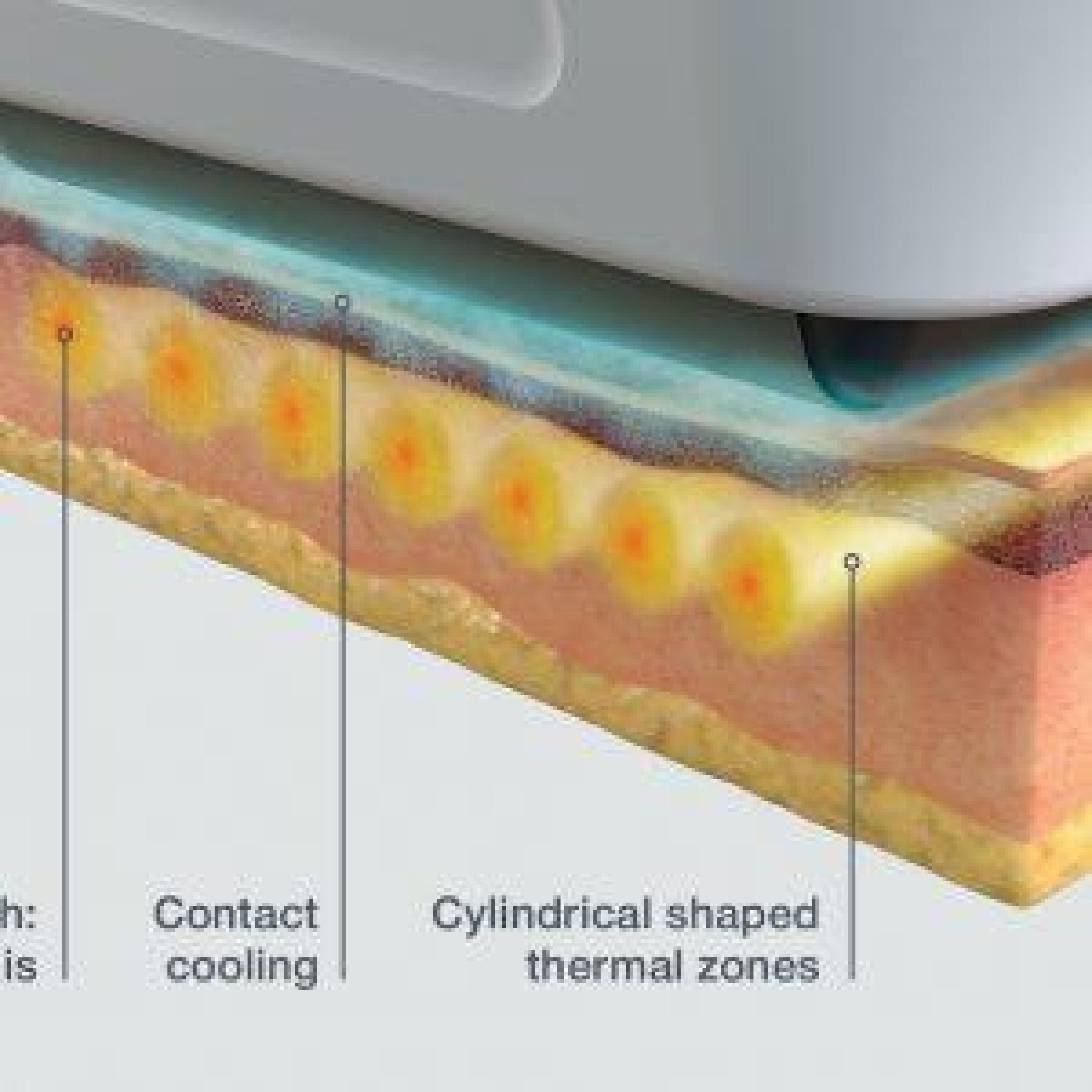 Sofwave ultrasound tightening Dermanence