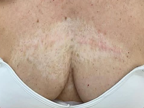 permanent camouflage vitiligo hautarztpraxis zurich a