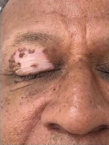 permanent camouflage vitiligo hautarztpraxis zurich a